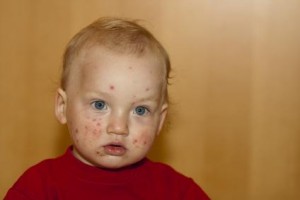 Rote Flecken mit häufig auftretendem Juckreiz sind ein typisches Anzeichen für eine Infektion mit dem Windpocken-Virus. gefunden auf: https://www.was-sind-windpocken.de/